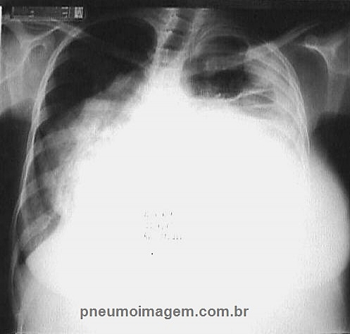 DIRETRIZ PARA O MANEJO DO DERRAME PLEURAL MALIGNO: FA�A O DOWNLOAD